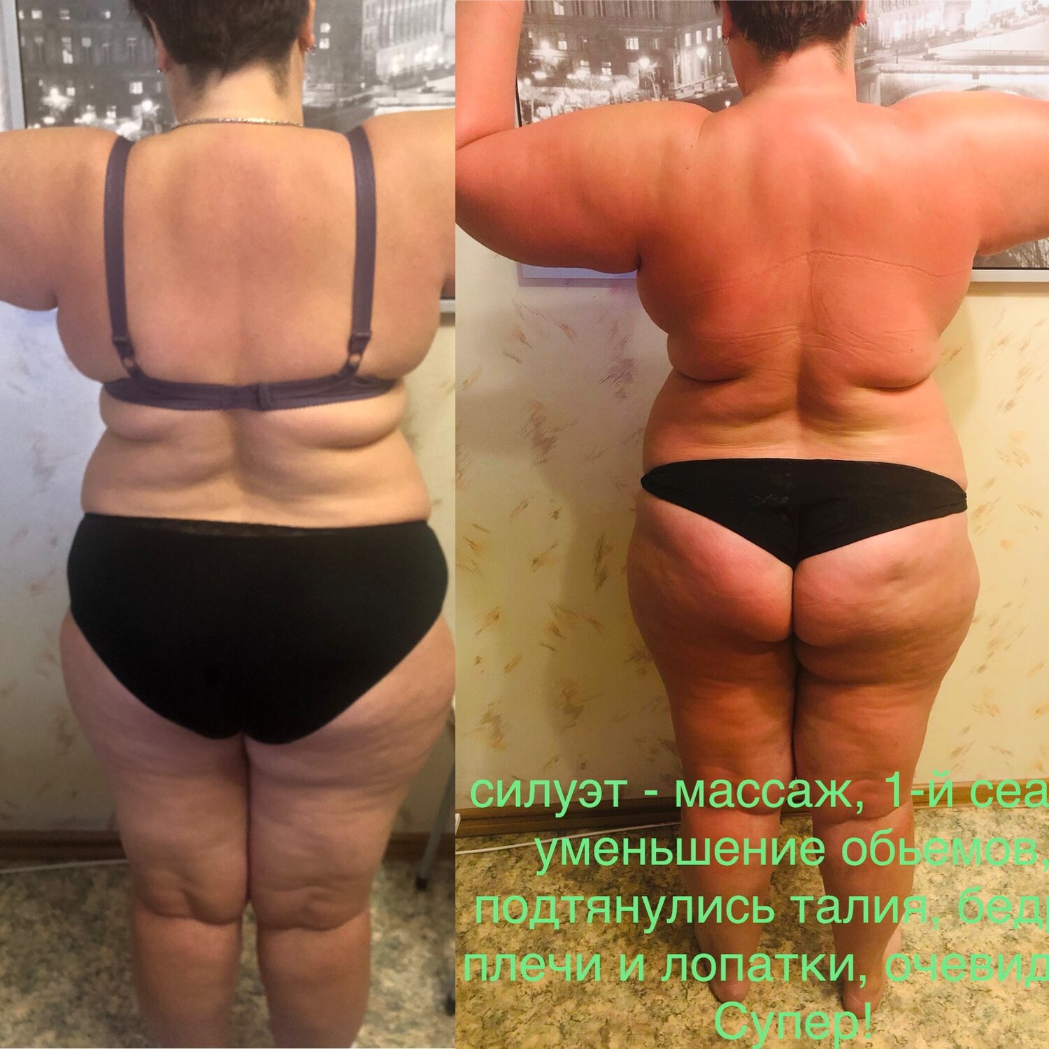 Антицеллюлитный массаж