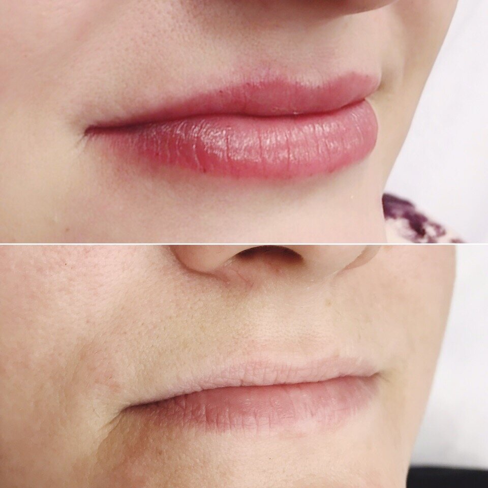 контур губ ювидерм 3, гиалуроновая кислота в губы stylage, неровный контур губ, плазмолифтинг губ, татуаж губ после коррекции
