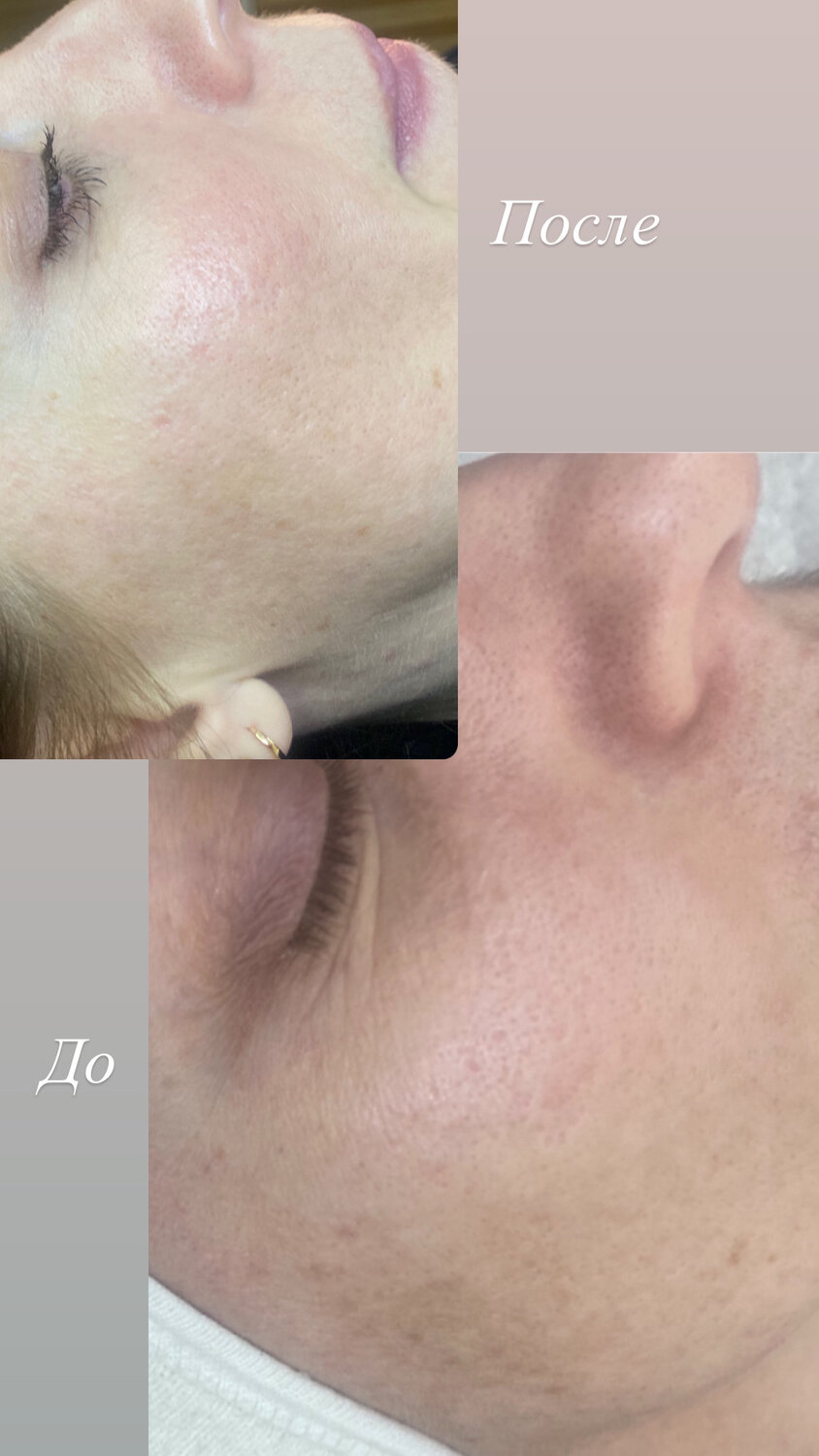 до и после лазерной шлифовки лица, лазерная шлифовка гипертрофических рубцов, лицо после лазерной шлифовки, до и после чистки лица, биоревитализации лица до и после эффект