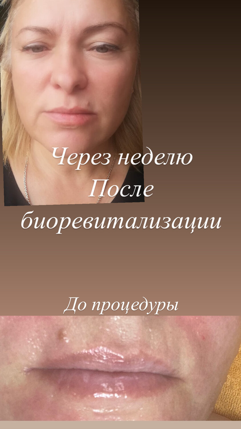 биоревитализации лица, процедура биоревитализации лица, после увеличения губ, электропорация губ гиалуроновой кислотой, процедура
