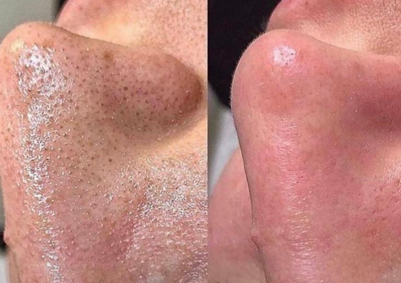 чистка лица, комбинированная чистка лица, после чистки лица, чистка кожи лица, до и после чистки лица