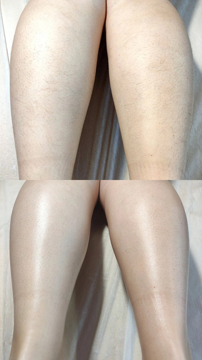 восковая депиляция, депиляция сахаром, депиляция, шугаринга, шугаринг депиляция