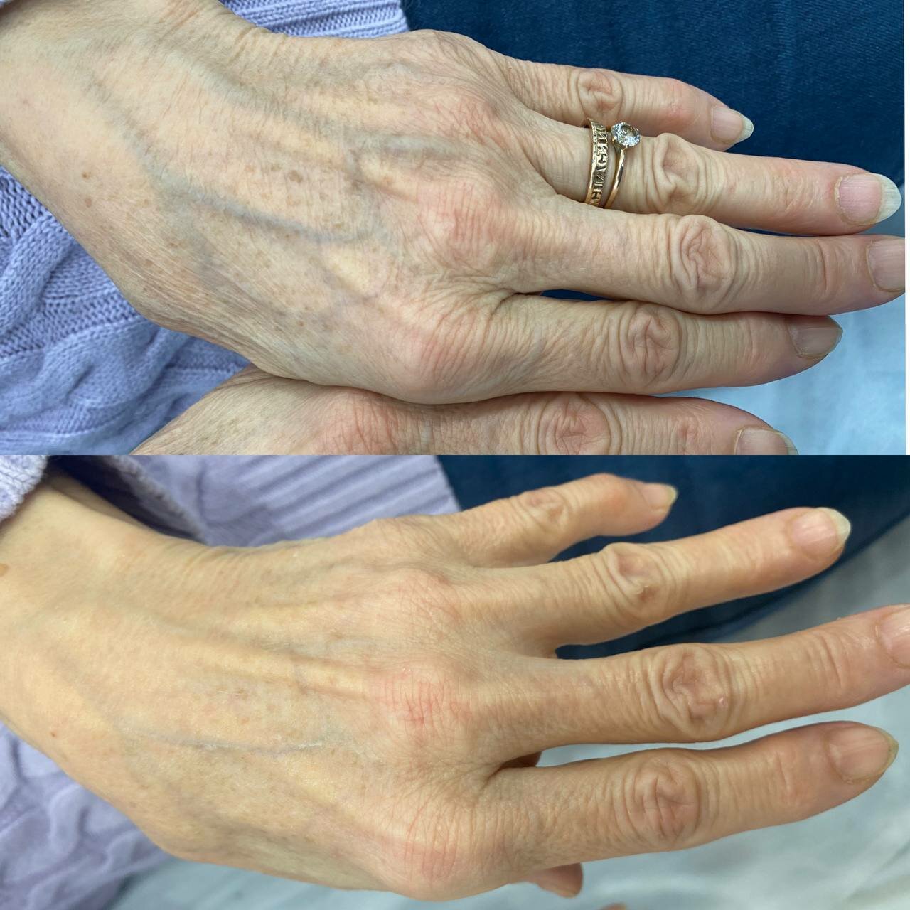 часть тела, омоложение рук, кисть руки, рука, омоложение кистей рук