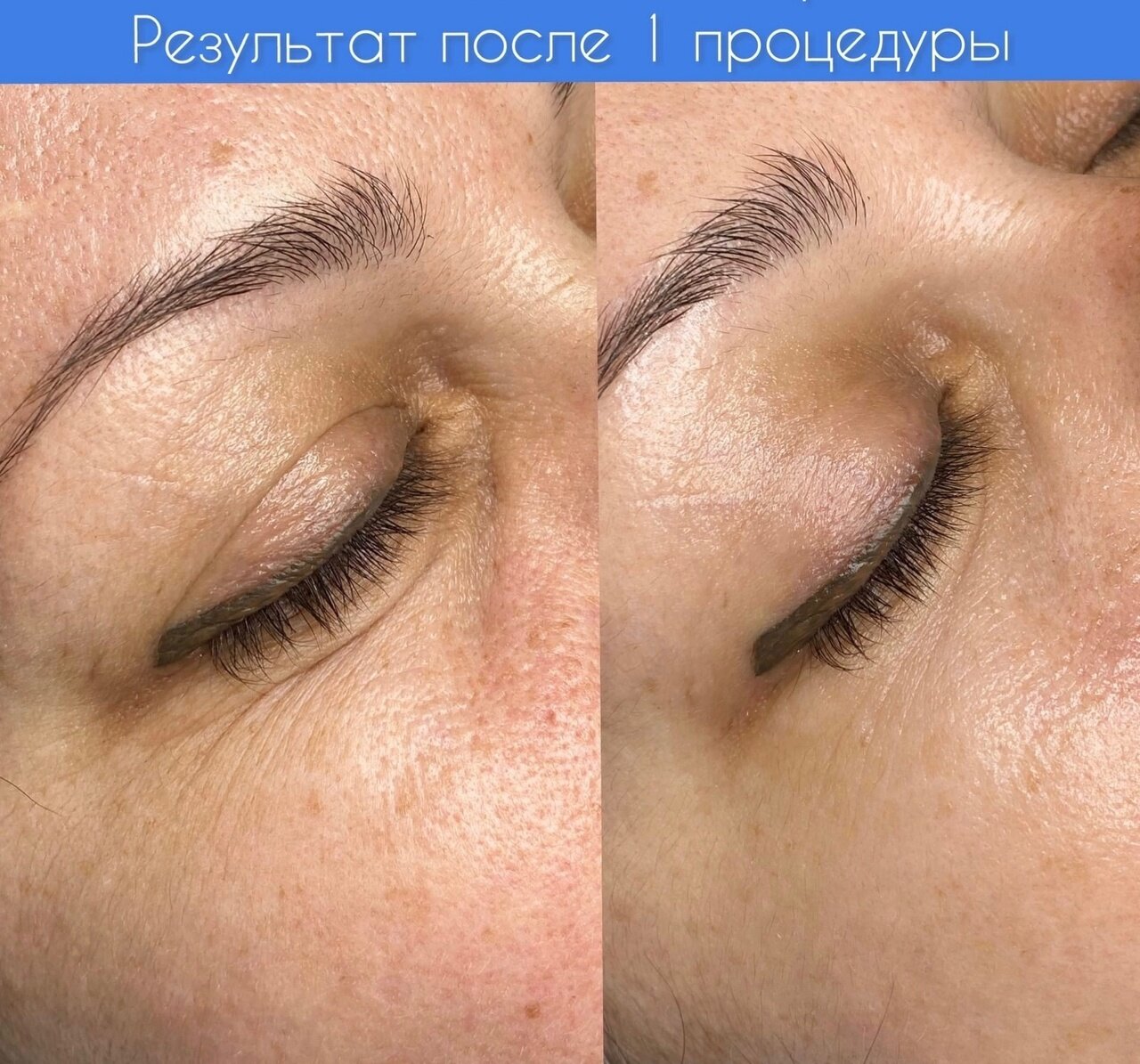 татуаж, удаление лазером татуажа, удаление татуажа бровей лазером, удаление татуажа, напыление бровей