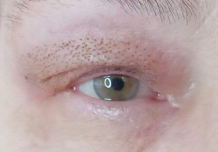 часть лица, лица, безоперационная блефаропластика plasma liner, глаз, век