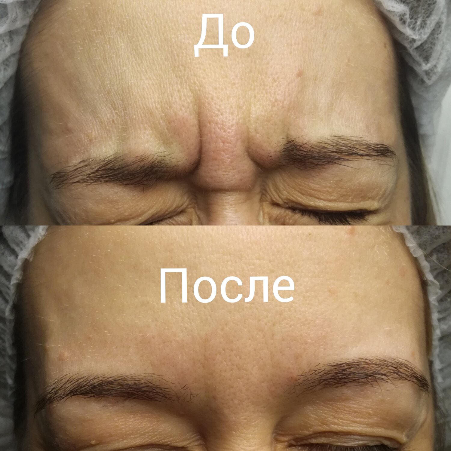 до и после, после, часть лица, лица, морщины