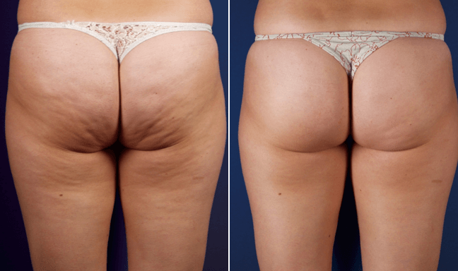 Механическая чистка лица Blurion