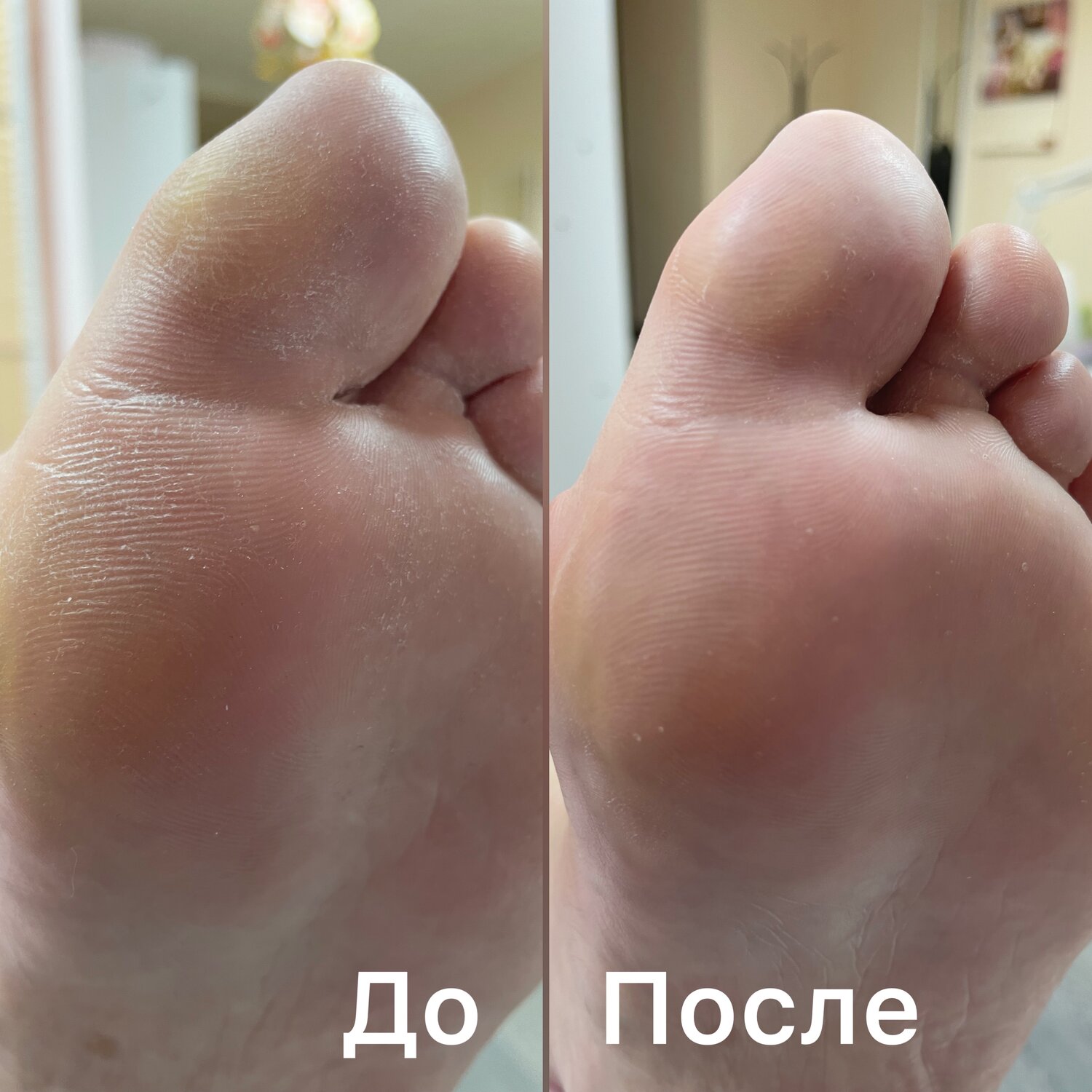 педикюр, сложный педикюр, натоптыши, педикюр гель, педикюр обработка стопы