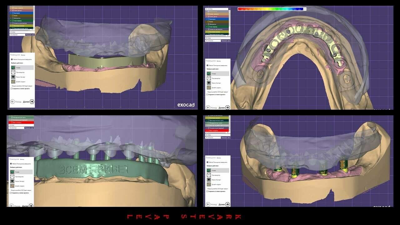 exocad, exocad моделирование зубов, exocad каппа, моделировка зубов в exocad, cad/cam моделирование exocad