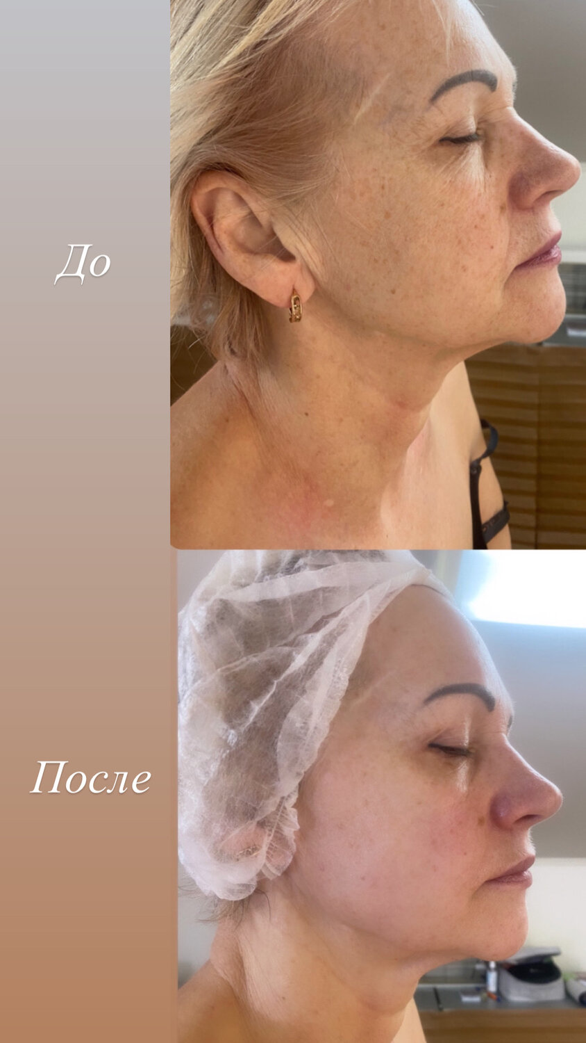 лифтинг лица, smas лифтинг лица, смас лифтинг, микроигольчатый rf-лифтинг до и после, лифтинг