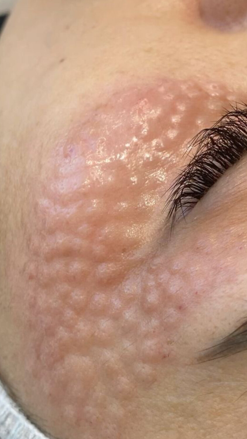 биоревитализация, папулы после биоревитализации, биоревитализация папулы, биоревитализация глаз, биоревитализация кожи вокруг глаз