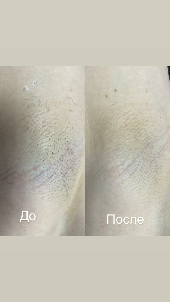 до и после лазерной эпиляции, результат после первой лазерной эпиляции, лазерная эпиляция до и после 1 процедуры, результат после лазерной эпиляции, после лазерной эпиляции
