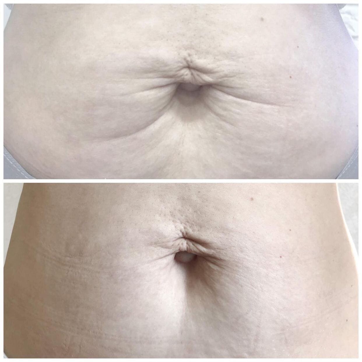 после, термаж тела до и после, безоперационная подтяжка кожи живота, подтяжка кожи тела, следы на коже