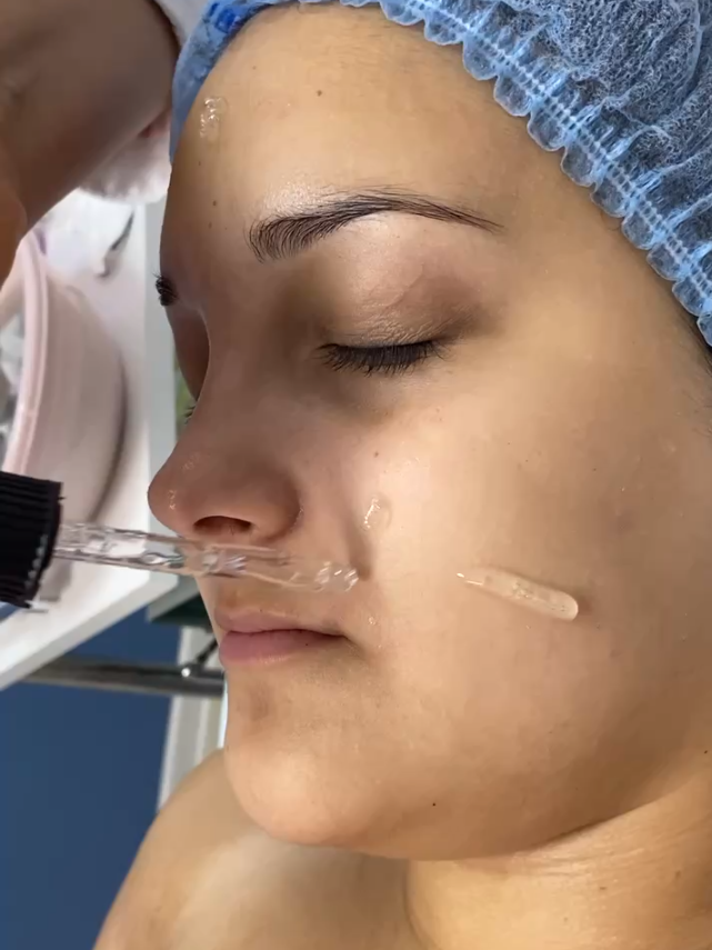 нити лицо, тредлифтинг, подтяжка лица мезонитями, пилинг, контурная пластика филлерами