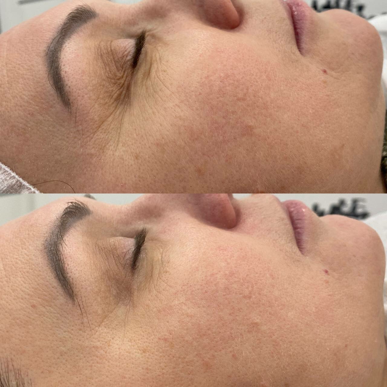 пилинг, пилинг лица, чистка лица пилинг, уз чистка лица, процедуры для лица