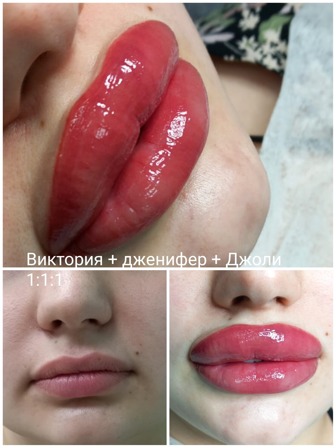 губы гиалуроновой, увеличение губ, губы 👄, пластика губ, губы гиалуроновой кислотой