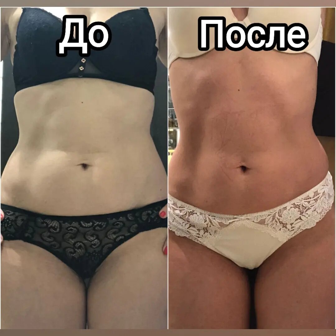 часть тела, криолиполиз до и после, живот после криолиполиза, лазерный липолиз, прессотерапия до и после