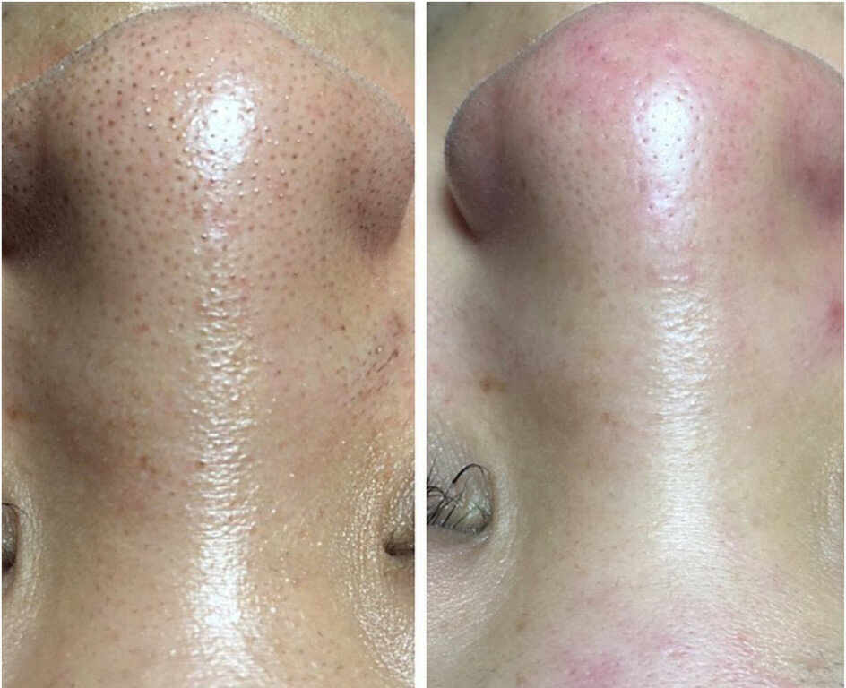 после чистки лица, чистка лица, механическая чистка лица, комбинированная чистка лица, до и после чистки лица