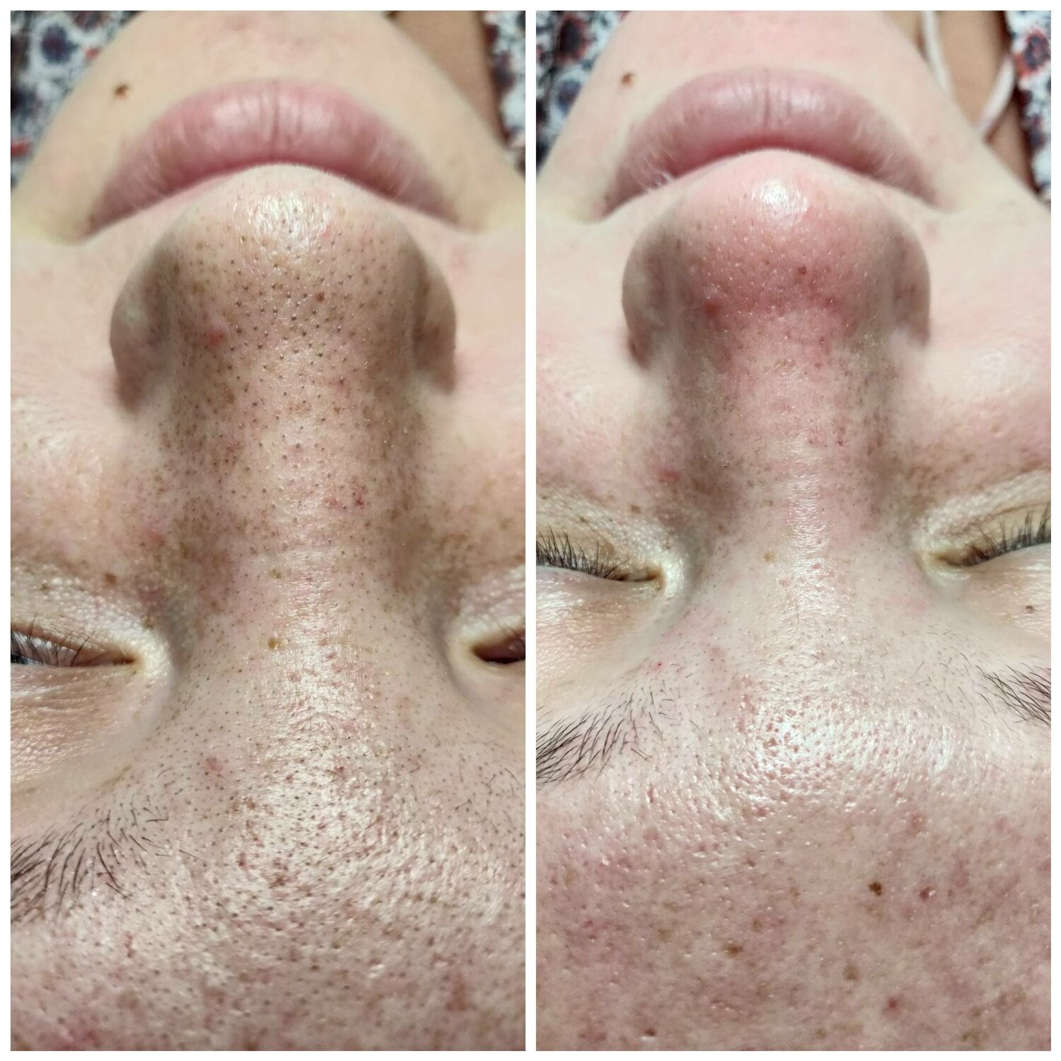 после чистки лица, чистка лица, лицо после ультразвуковой чистки, пилинг лица, до и после чистки лица