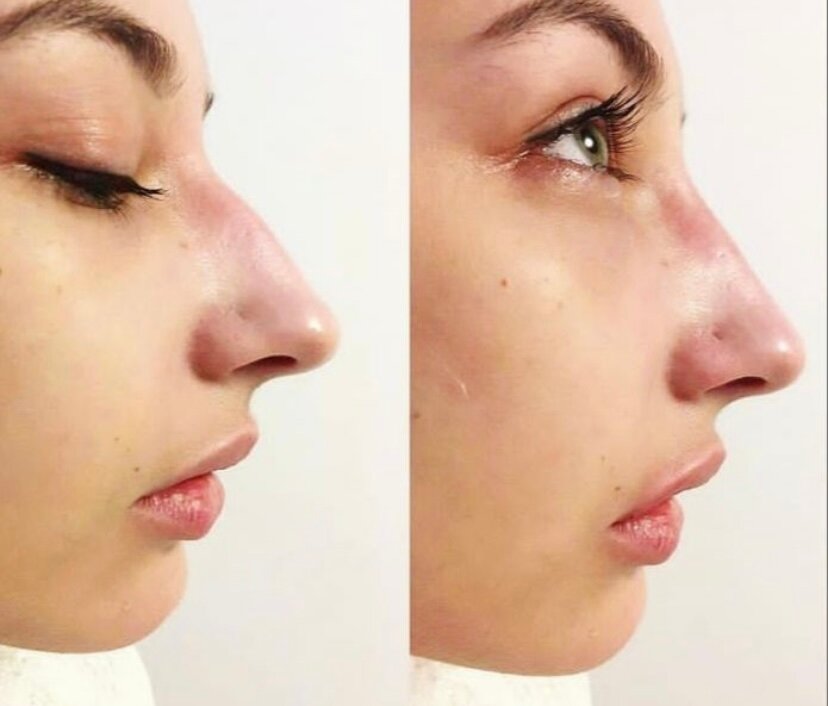 ринопластика носа, ринопластика горбинки носа, безоперационная ринопластика носа, ринопластика гюсан, пластика носа