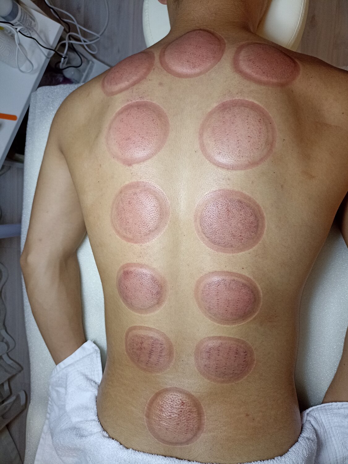спина после банок, спина после хиджамы, cupping therapy, следы от баночного массажа, массаж спина