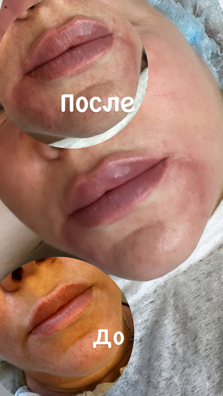 губы гиалуроновой, пластика губ, увеличение губ, губы контурная пластика, идеальные губы