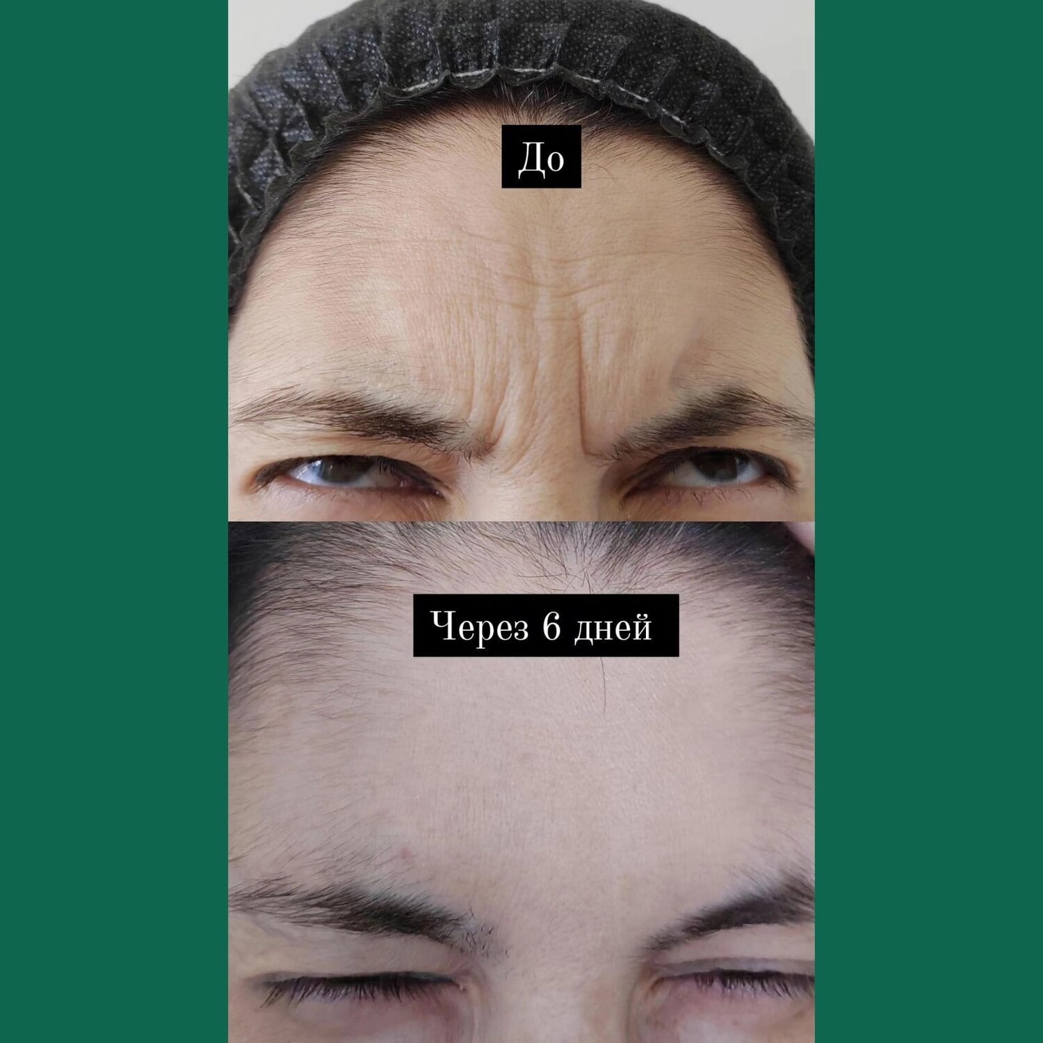 межбровье, морщины между бровями, ботокс для бровей, коррекция бровей, брови