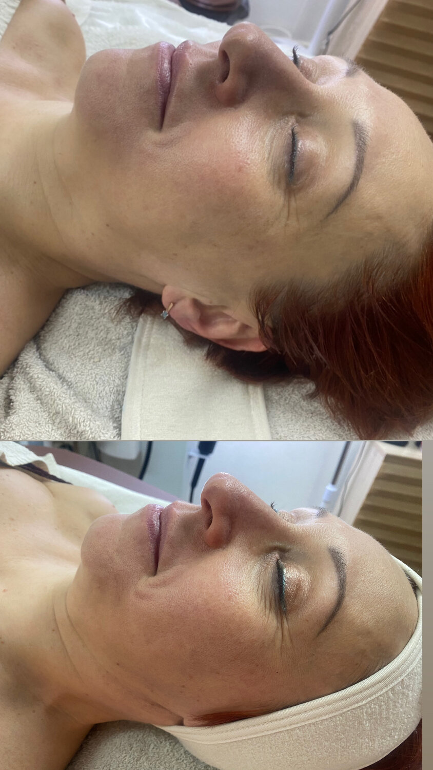 пилинг, биоревитализация лица и шеи, процедура, косметологии, процедуры для лица