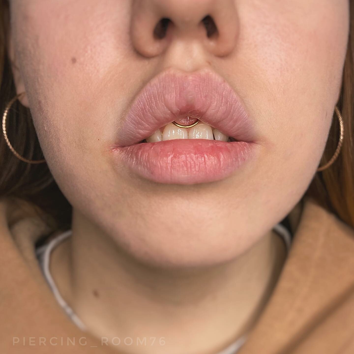 губы, увеличение губ, губы девушки, губы ботокс, сухие губы