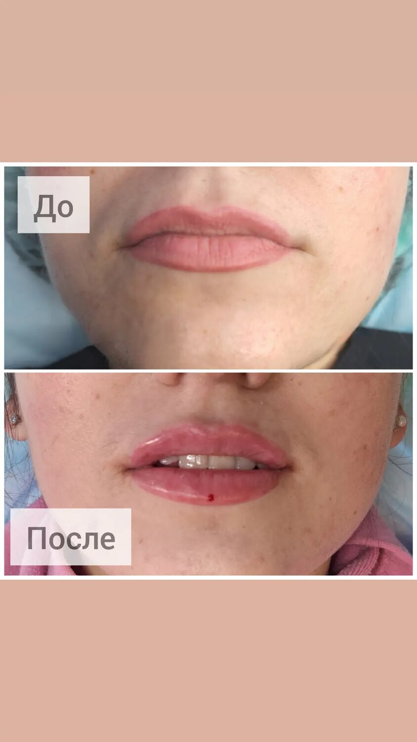 губы до и после увеличения 1 мл, губы после увеличения 1 мл, после увеличения губ, гиалуроновая кислота губы, пластика губ