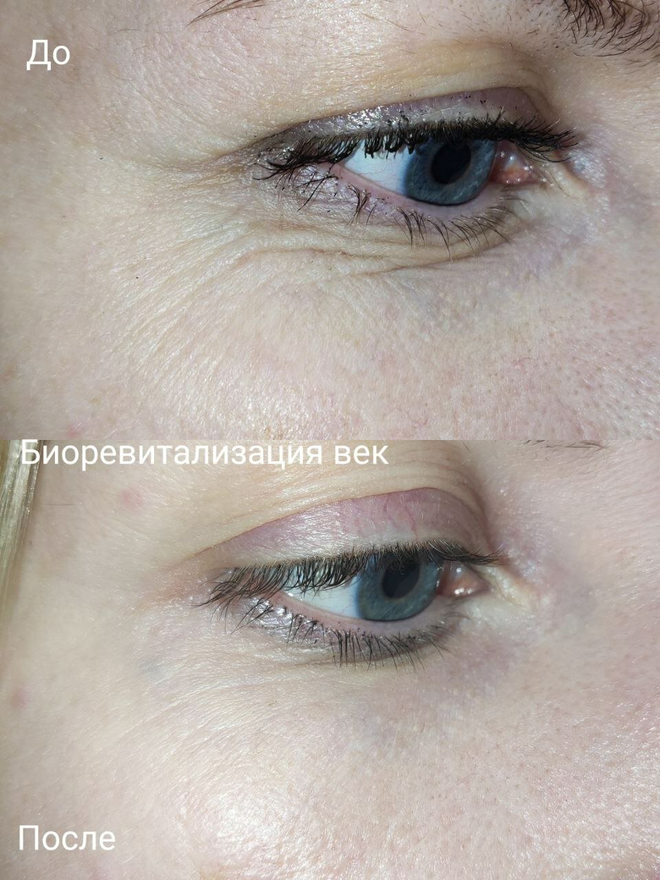 пластика век блефаропластика, блефаропластика нависших век, блефаропластика век, блефаропластика, рубцы после блефаропластики