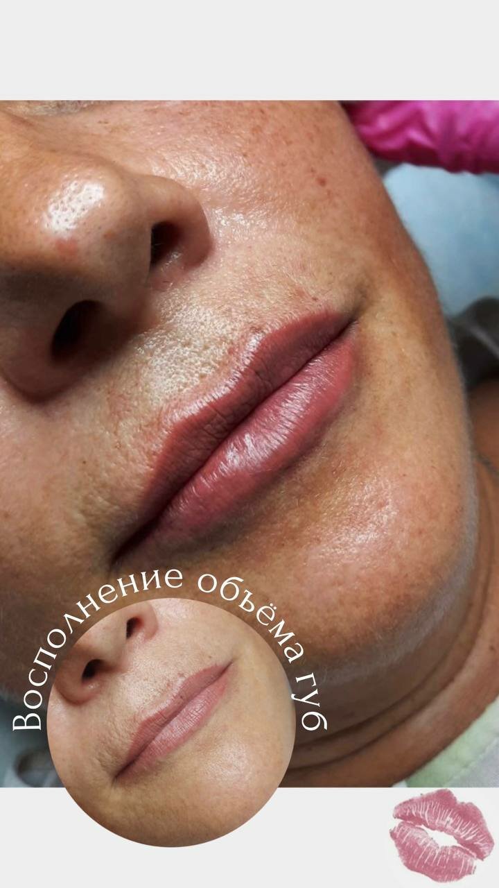 ювидерм ультра, увеличение губ, губы филлером, увеличение губ филлером, губы после увеличения