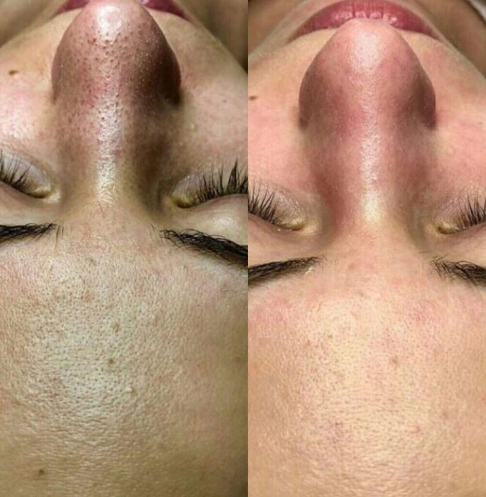 кожа после чистки лица, чистка лица, после чистки лица, лазерная чистка лица, уз чистка лица