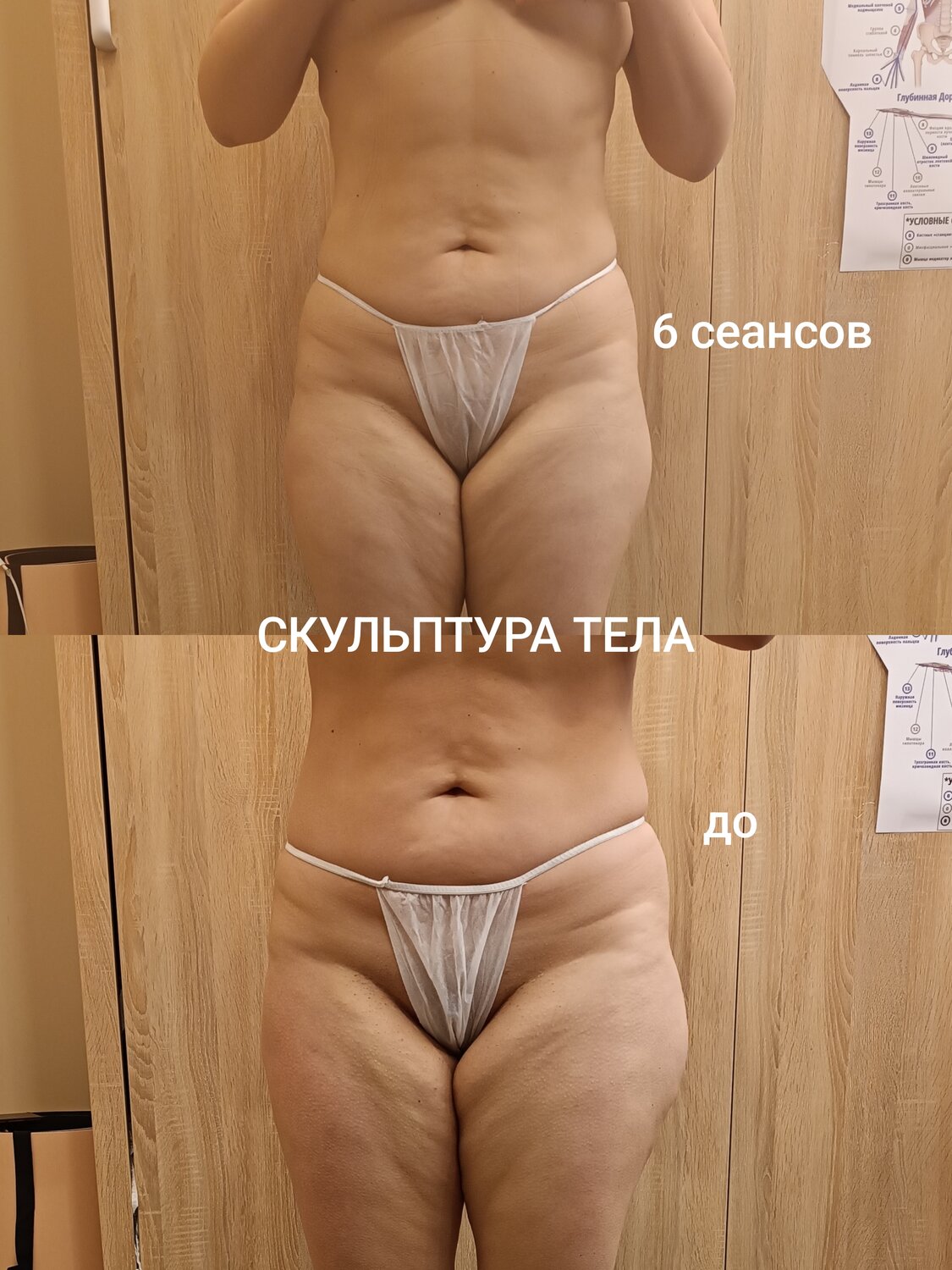 коррекция фигуры, липосакция тела, липоскульптура тела, липомоделирование тела, липосакции