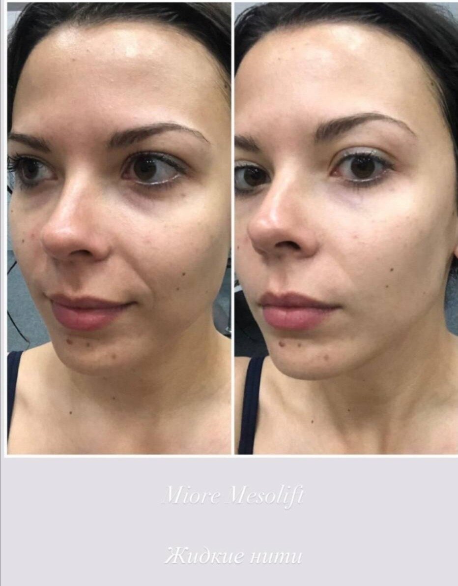 микротоки для лица до и после, hydrafacial до после, ультраформер лифтинг альтера, липофилинг носослезных борозд, смас лифтинг эффект