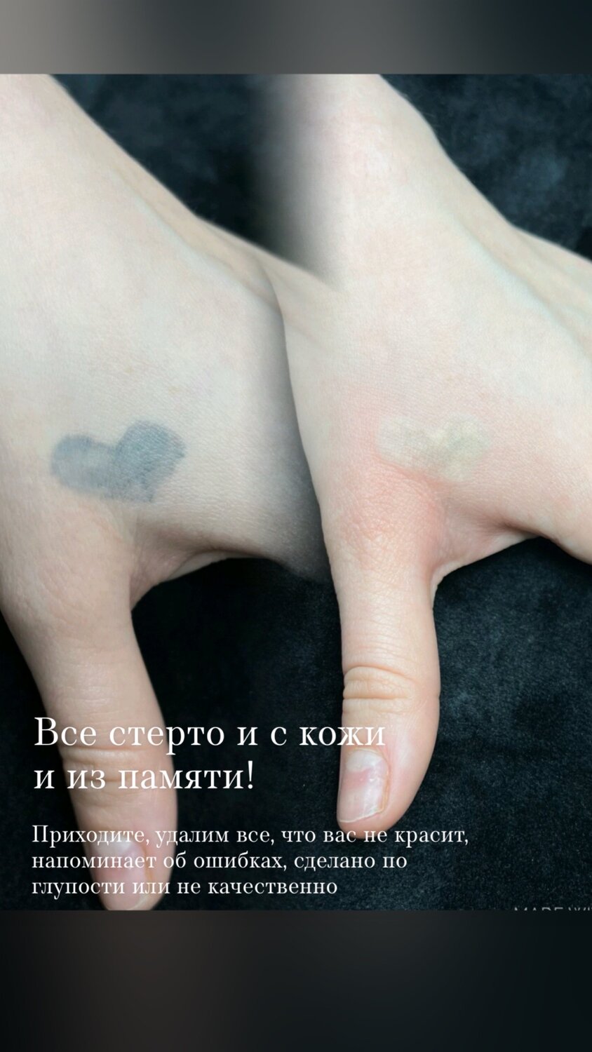 лазерное удаление татуировок, тату, удаление тату, удаление татуировки, удаление тату лазером