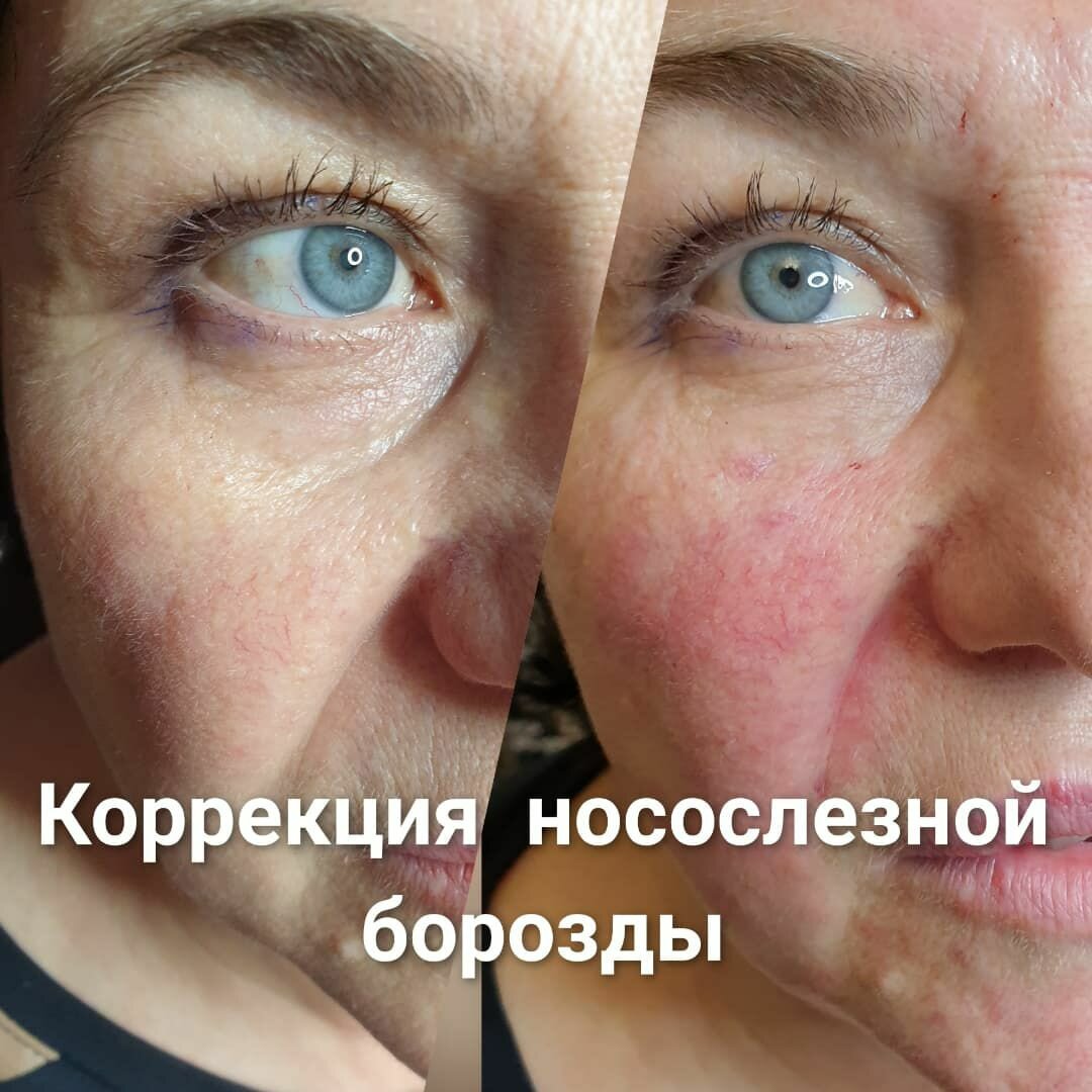 контурная коррекция носослезной борозды, коррекция носослезной борозды, коррекция носослезной борозды филлерами, контурная пластика носослезной борозды, коррекция носослезной борозды у мужчин