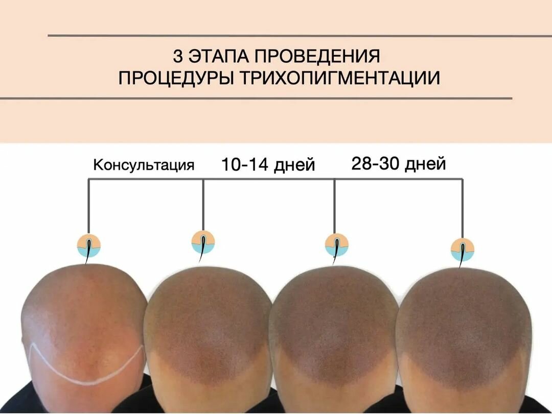 трихопигментация, трихопигментация рубцов, трихопигментация синяя, формы головы, темечко на голове