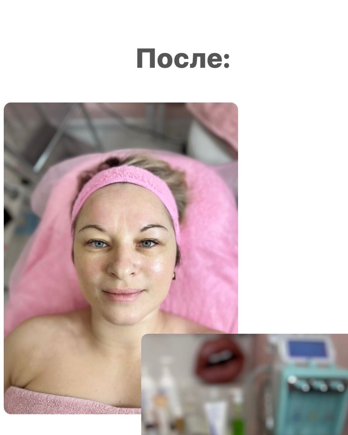 пилинг лица, процедуры для лица, косметика, пилинг, косметические процедуры