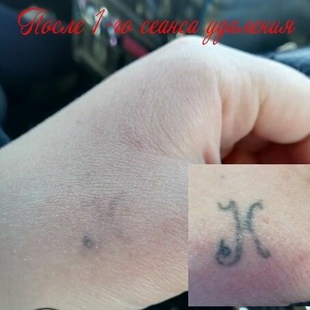 тату, удаление татуировок лазером, удаление татуировок, удаление тату лазером, выведение тату лазером