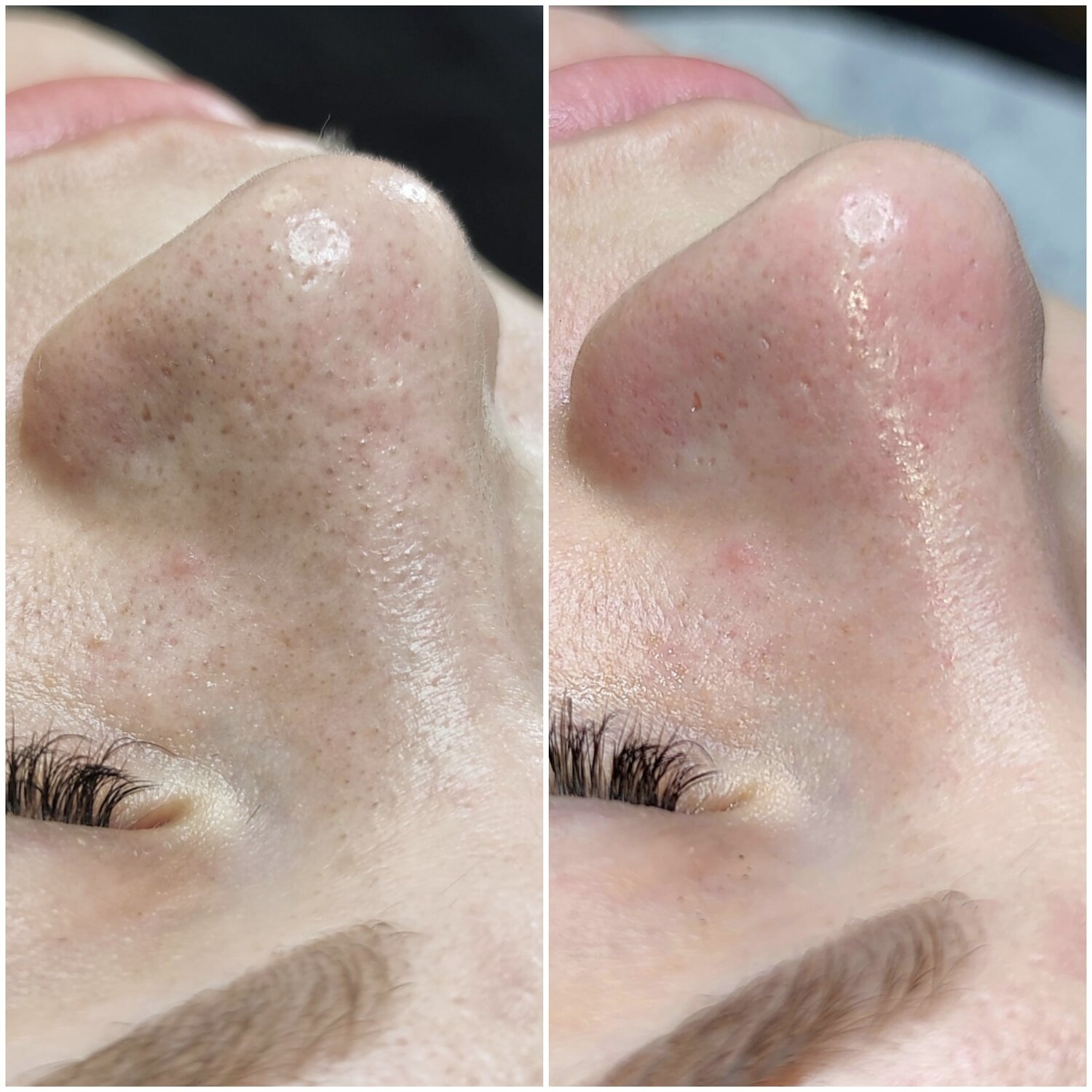 чистка лица, комплексная чистка лица, механическая чистка лица, комбинированная чистка лица, пилинг