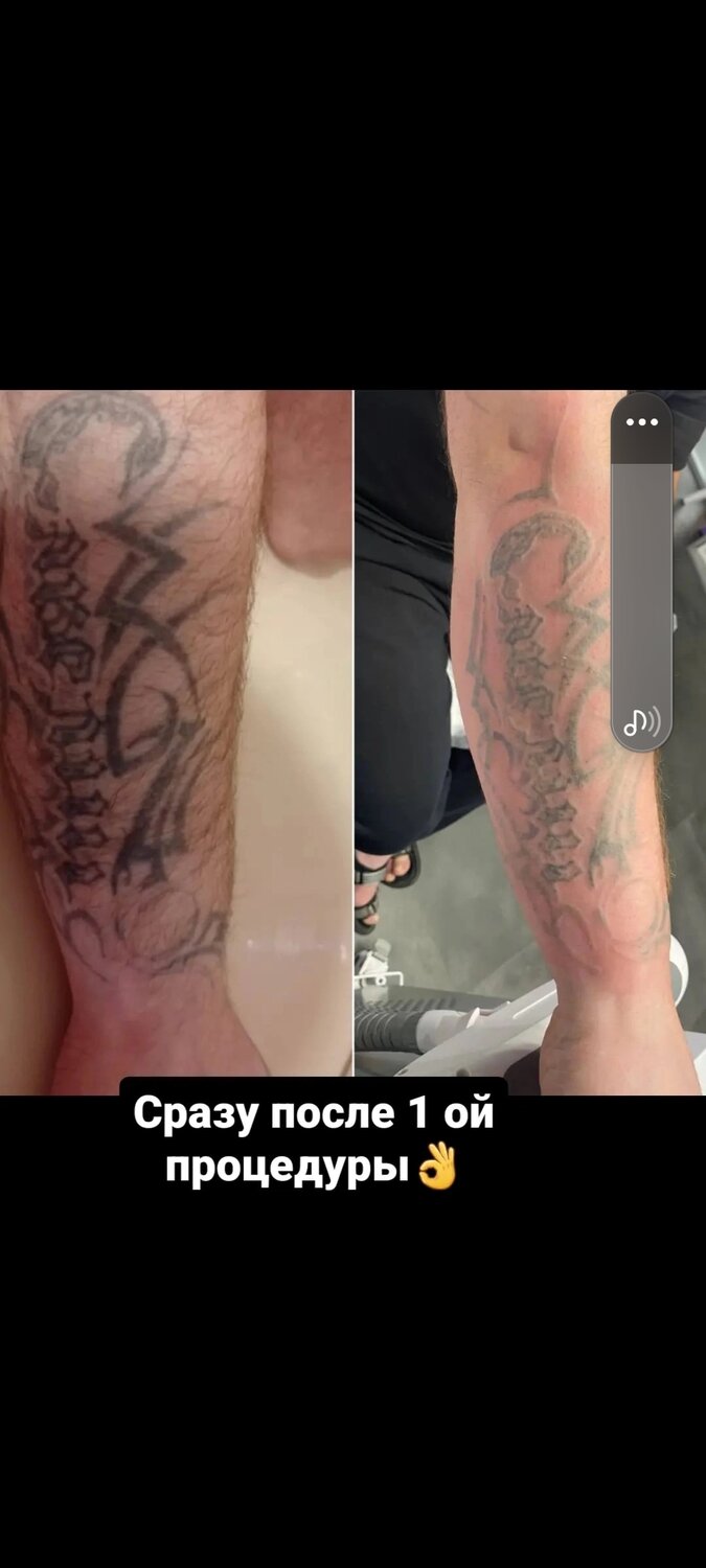 выведение татуировок лазером, удаление тату лазером, тату после лазера, удаление татуировок лазером, удаление тату после первого сеанса