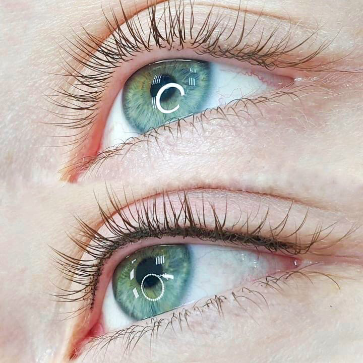 Что такое межресничка фото до и после