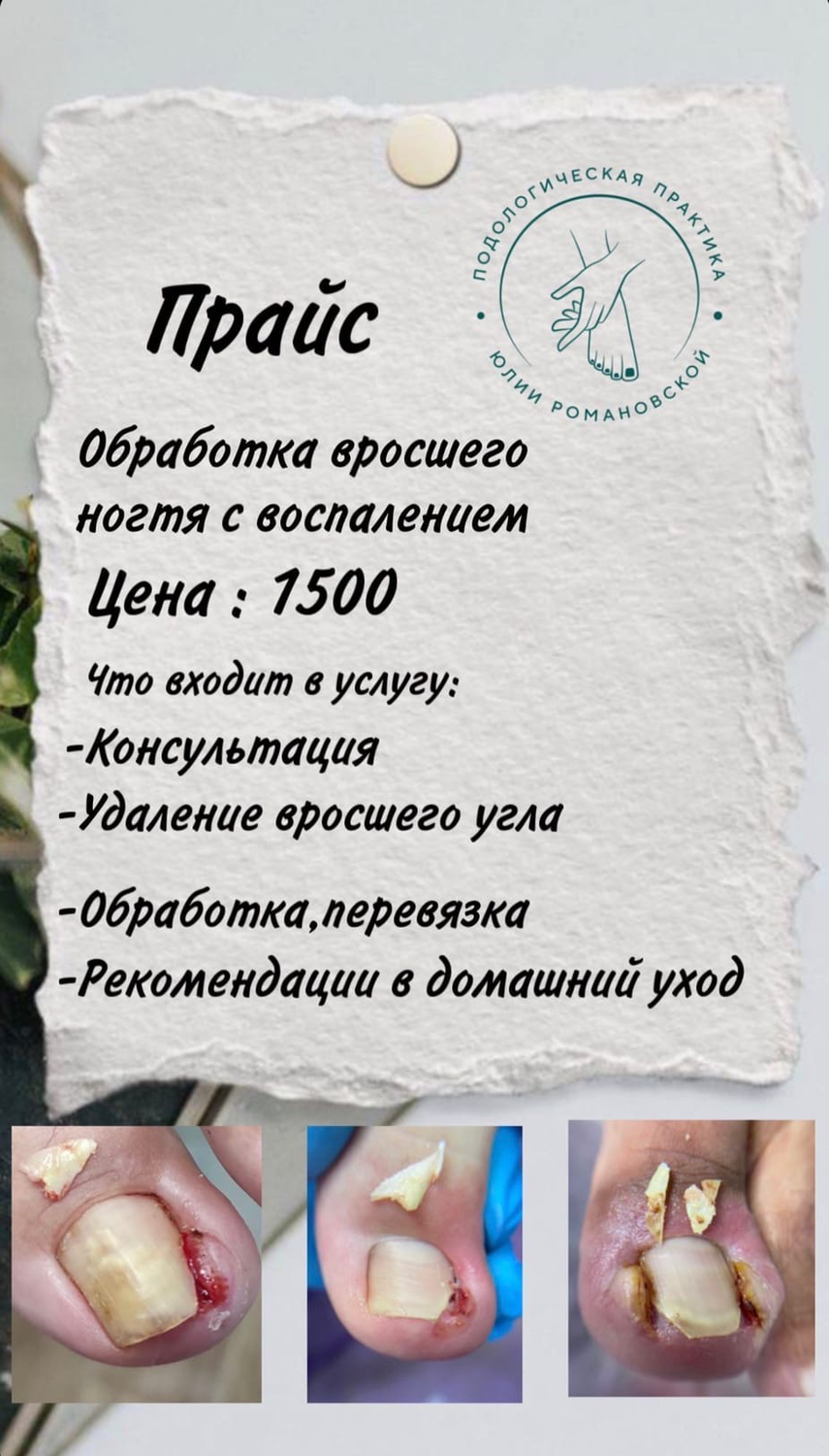 обработка вросшего ногтя, вросший ноготь с грибком, система для вросших ногтей, лечение вросшего ногтя, коррекция вросшего ногтя