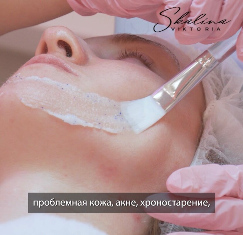 чистка лица, пилинг лица, химический пилинг, уз чистка лица, пилинг