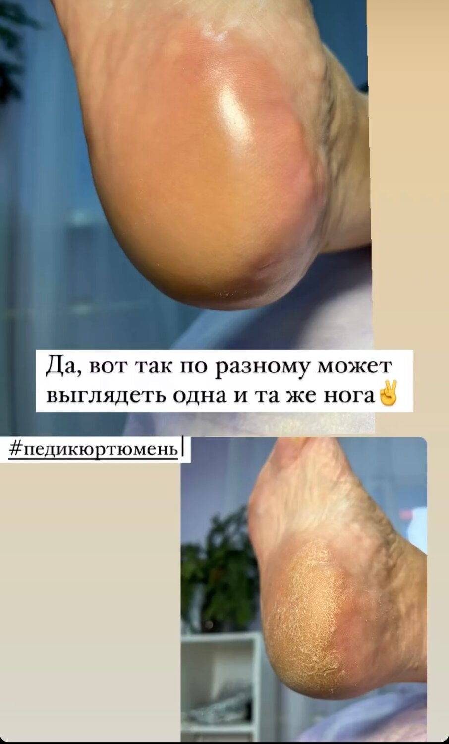 педикюр, шпора на ноге, стопа, шпора на ступне, пяточная шпора