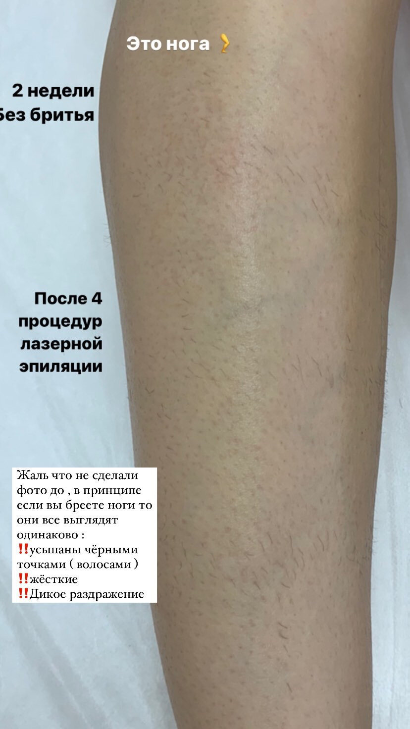 подготовка к лазерной эпиляции, электроэпиляция, часть тела человека, лазерная эпиляция до и после, эпиляция