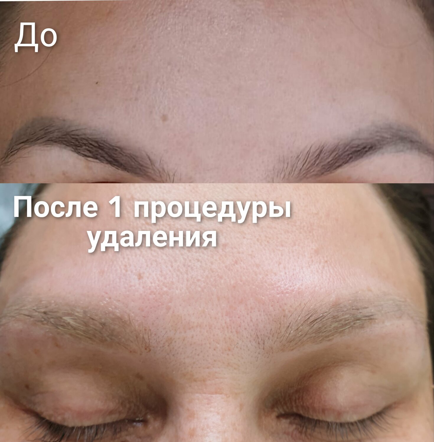чистка лица до и после татуажа, лицо после курса пилингов, зачем делать процедуры курсом, процедура, удаление татуажа неодимовым лазером красноярск