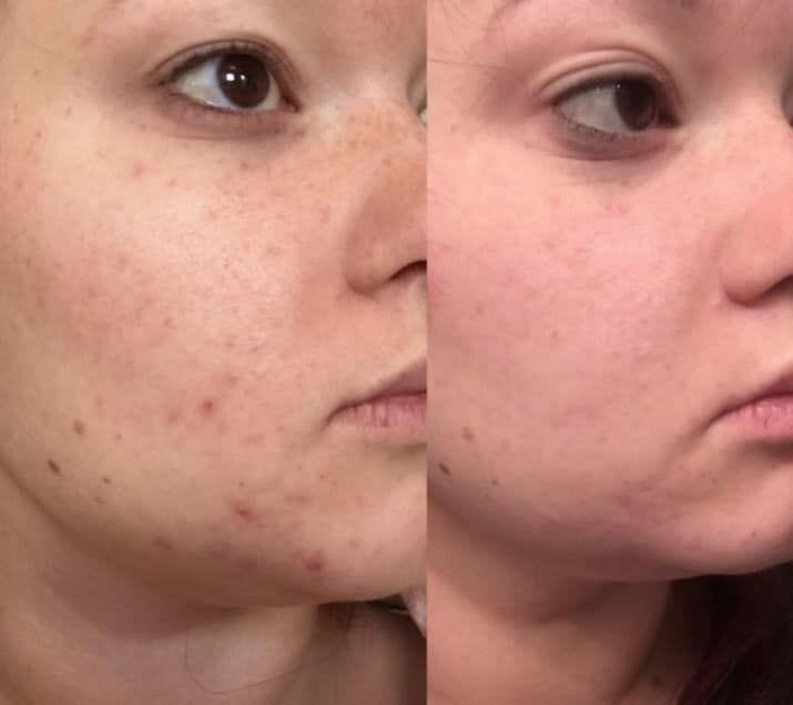 метрогил гель от прыщей до после, пилинг для лица, acne&oily до/после, метрогил от прыщей, пилинг