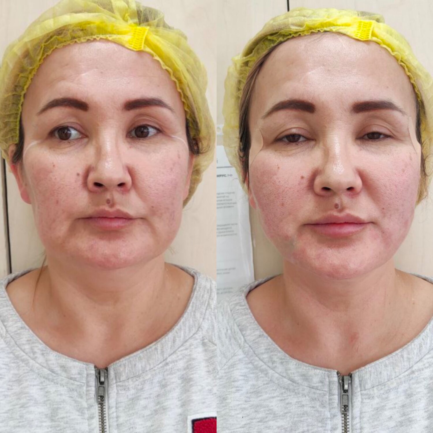 бьютификация лица, подтяжка лица, ботокс в нижнюю треть лица, часть лица, лицо